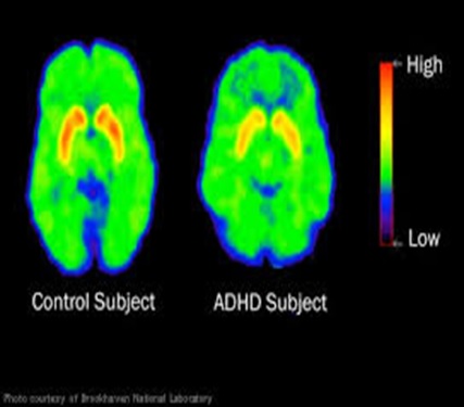 adhd-fig-1