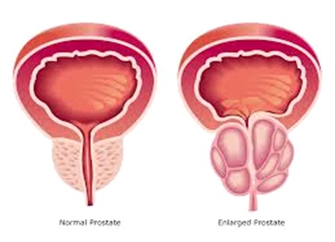 prostate-fig-1