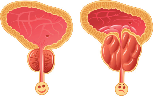 A cross section of two prostates, one healthy and one swollen