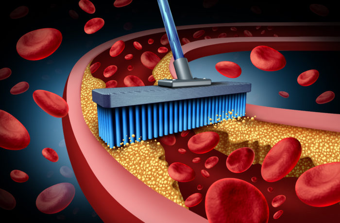 Animation of a brush removing a yellow substance from a blood vessel