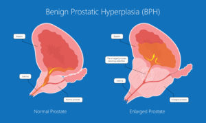 Diagram of a beneign prostatic hyperplasia