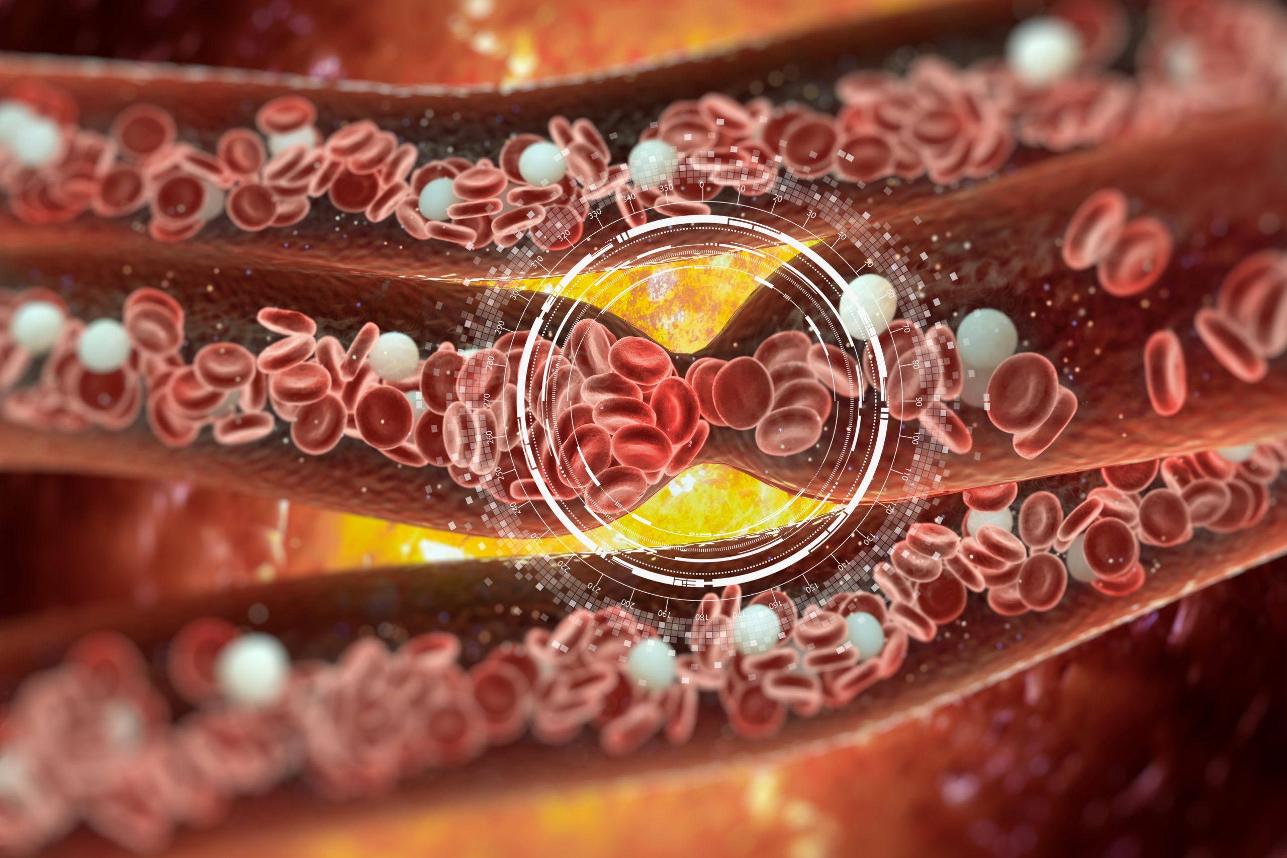 Red and white blood cells in a vein that has a slightly blocked area