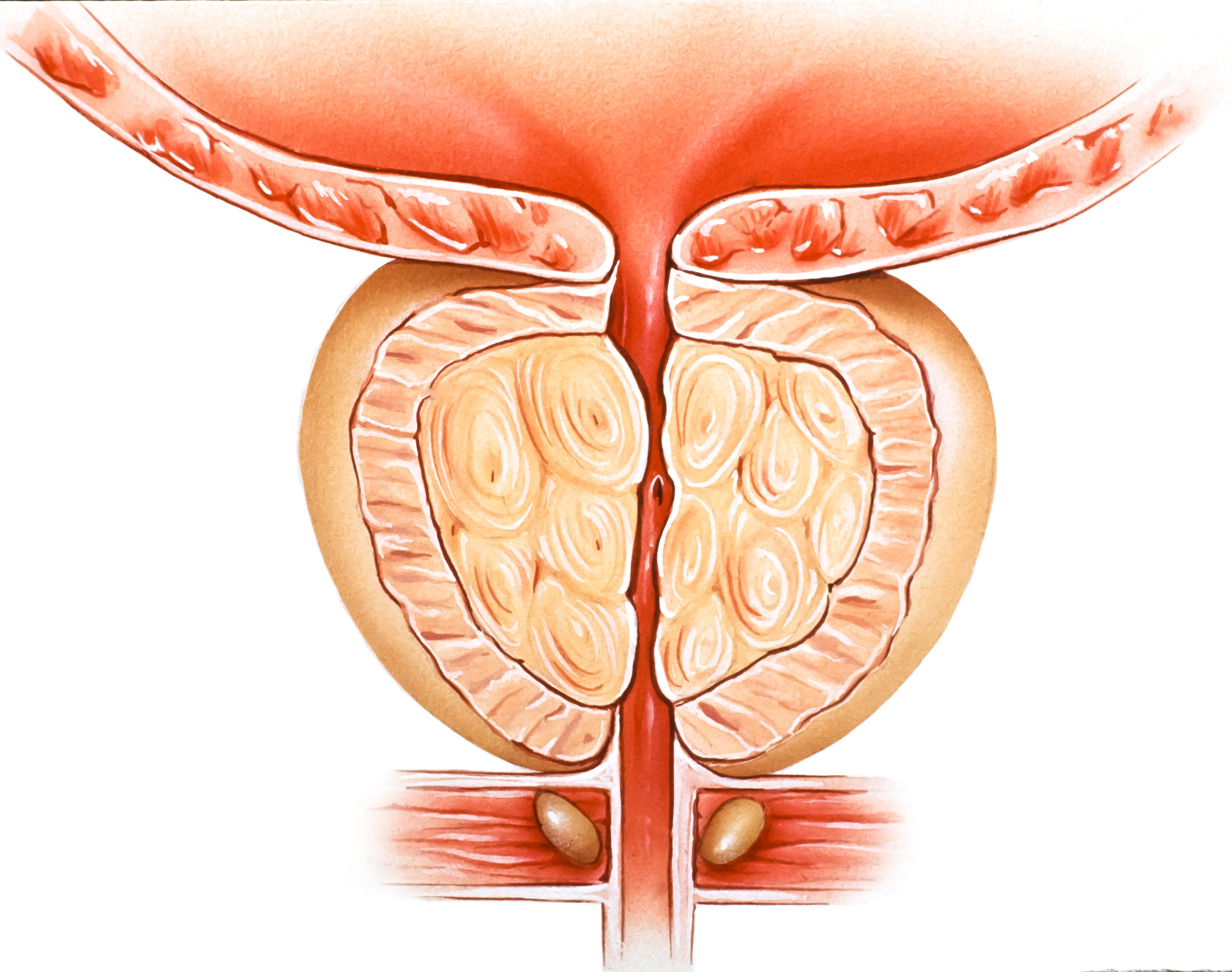 A diagram of Benign Prostatic Hyperplasia