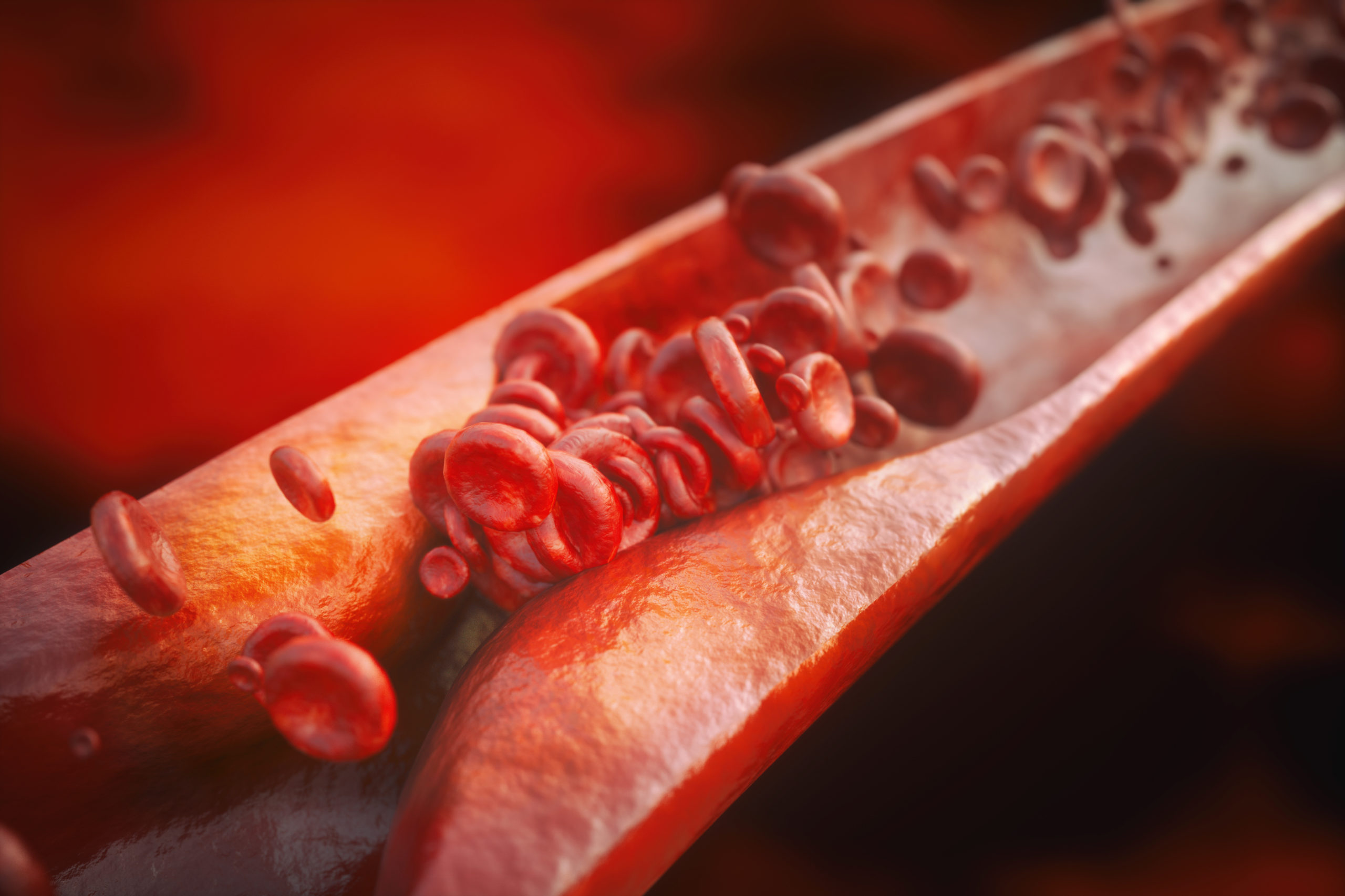 A 3D cross section of a vein and the red blood cells getting caught in a restricted area